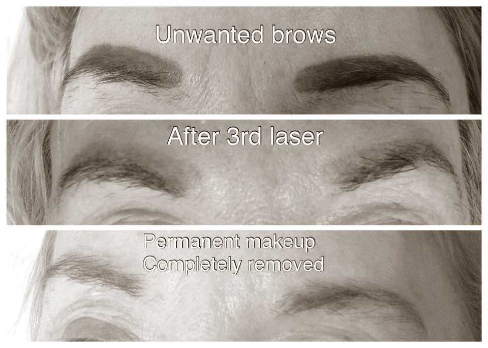 laser-eye-brow-removal-kidderminster-01 laser-eye-brow-removal-kidderminster-01