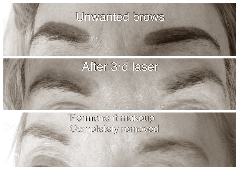 laser-eye-brow-removal-kidderminster-01
