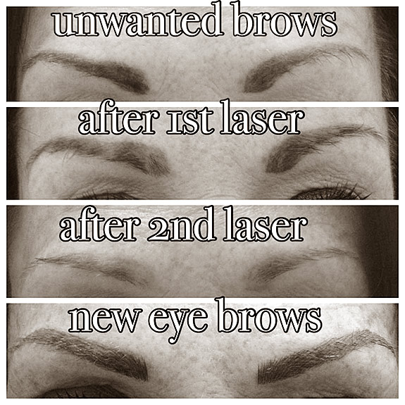 permanent-eye-brow-makup-removal-02