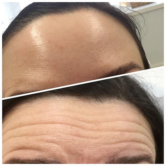 botox-anti-wrinkle-treatment-kidderninster