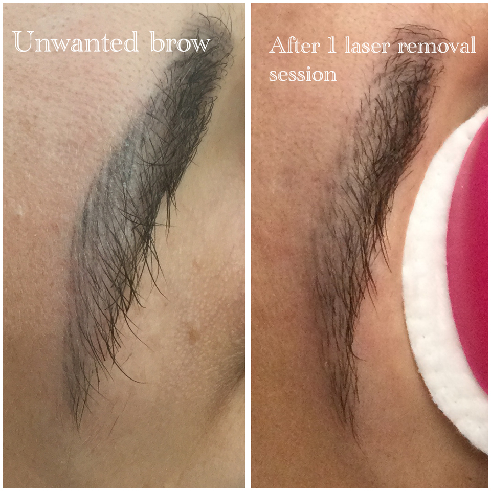 Eyebrow tattoo removal